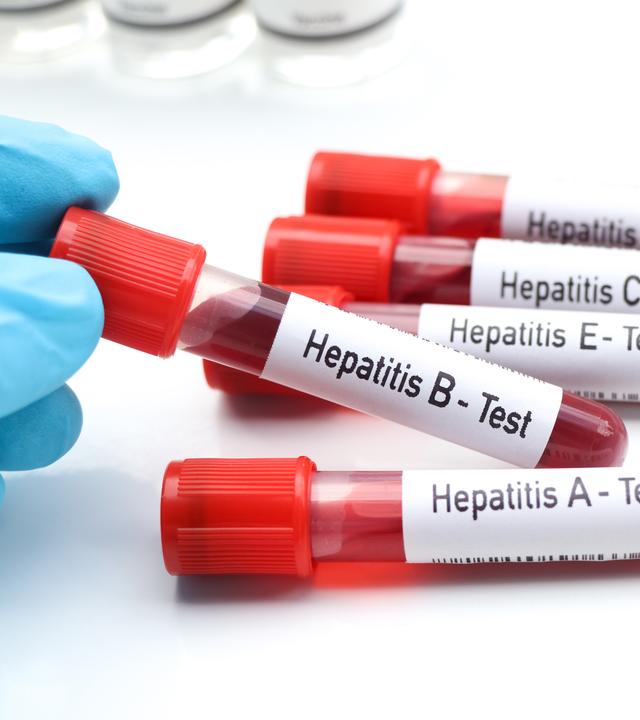 Mehrere Blutröhrchen mit Blut für Hepatitis Tests Virus A bis E.
