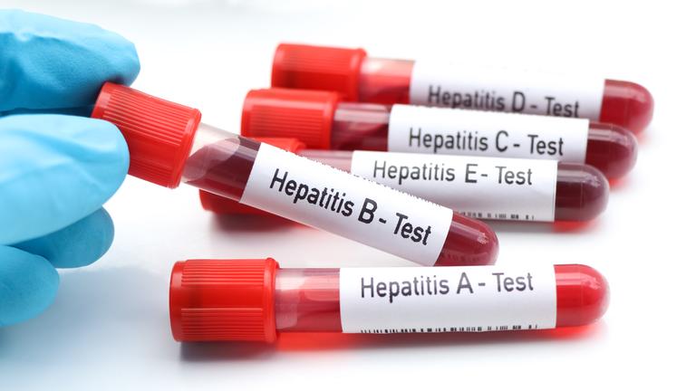 Mehrere Blutröhrchen mit Blut für Hepatitis Tests Virus A bis E.