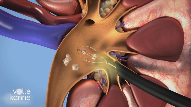 Harn- und Nierensteine