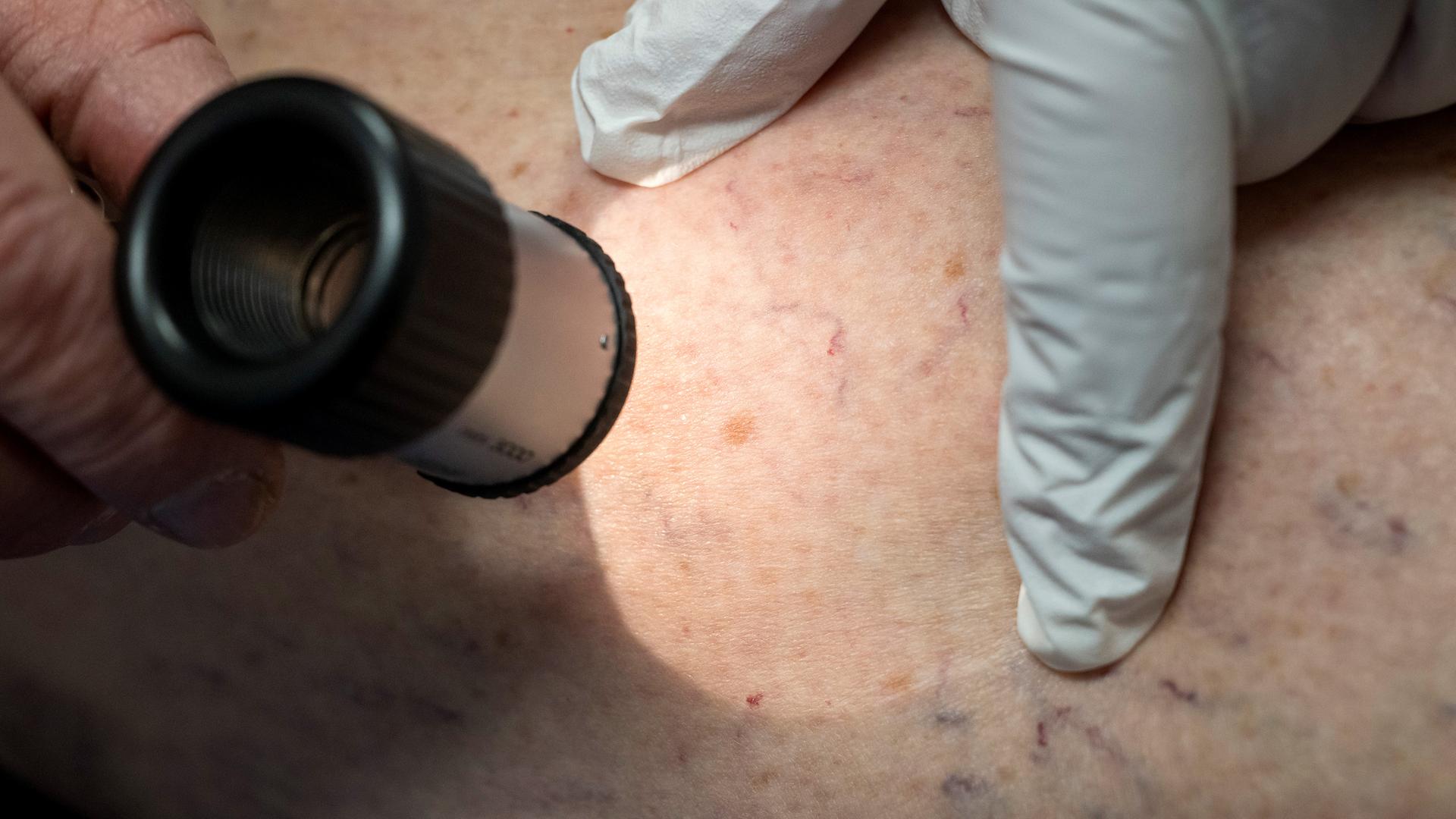 Ein Arzt untersucht in der Praxis die Hautpartie eines Patienten