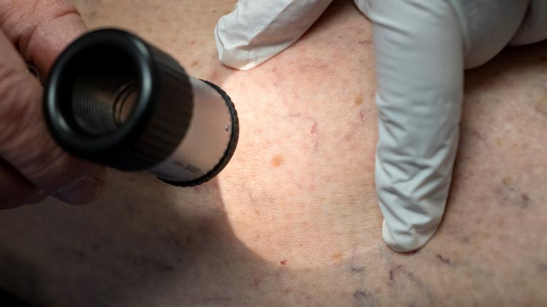 Ein Arzt untersucht in der Praxis die Hautpartie eines Patienten