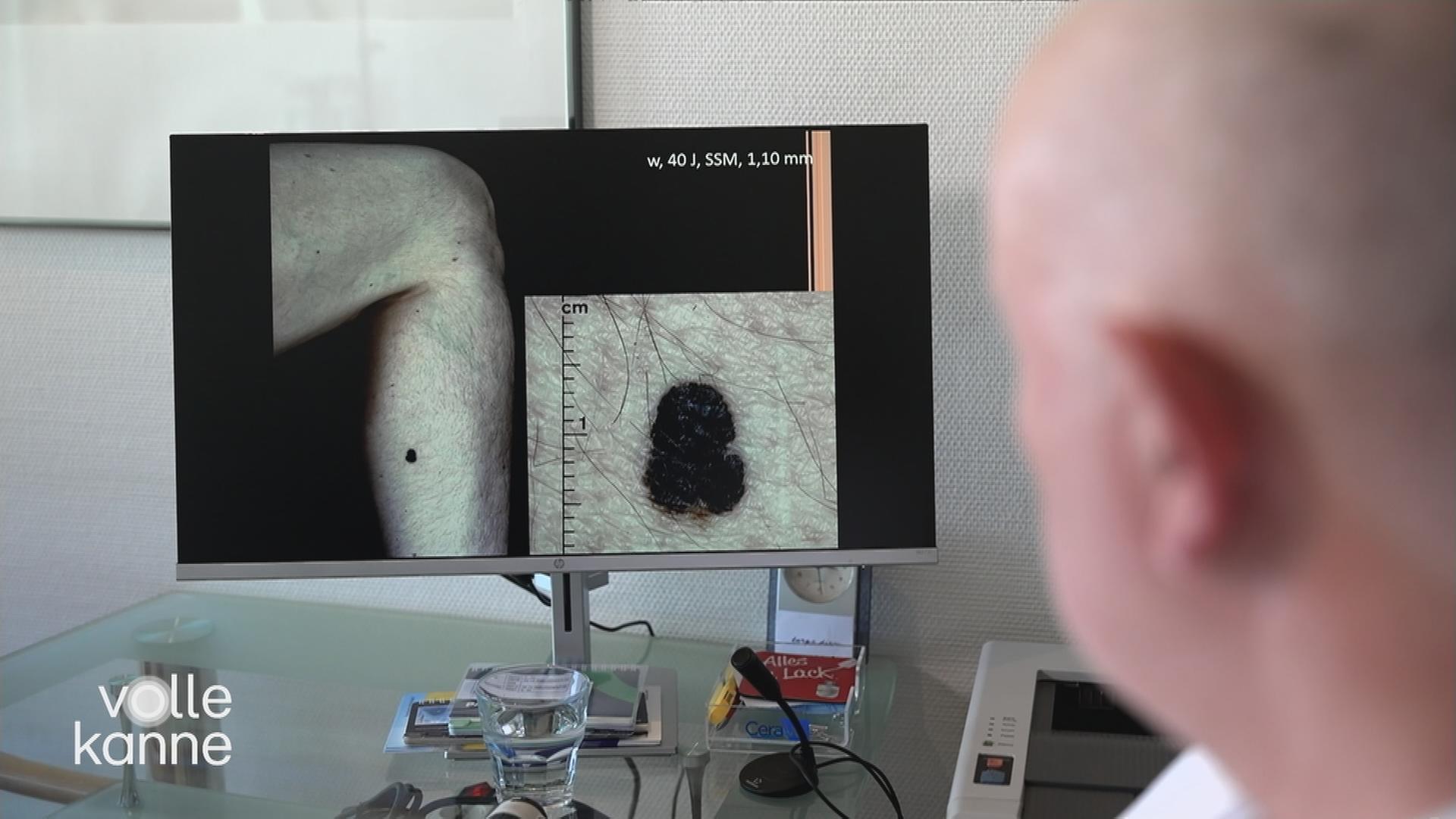 Diagnose Hautkrebs immer häufiger