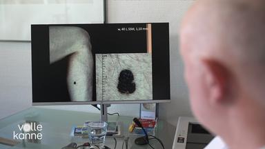 Diagnose Hautkrebs immer häufiger