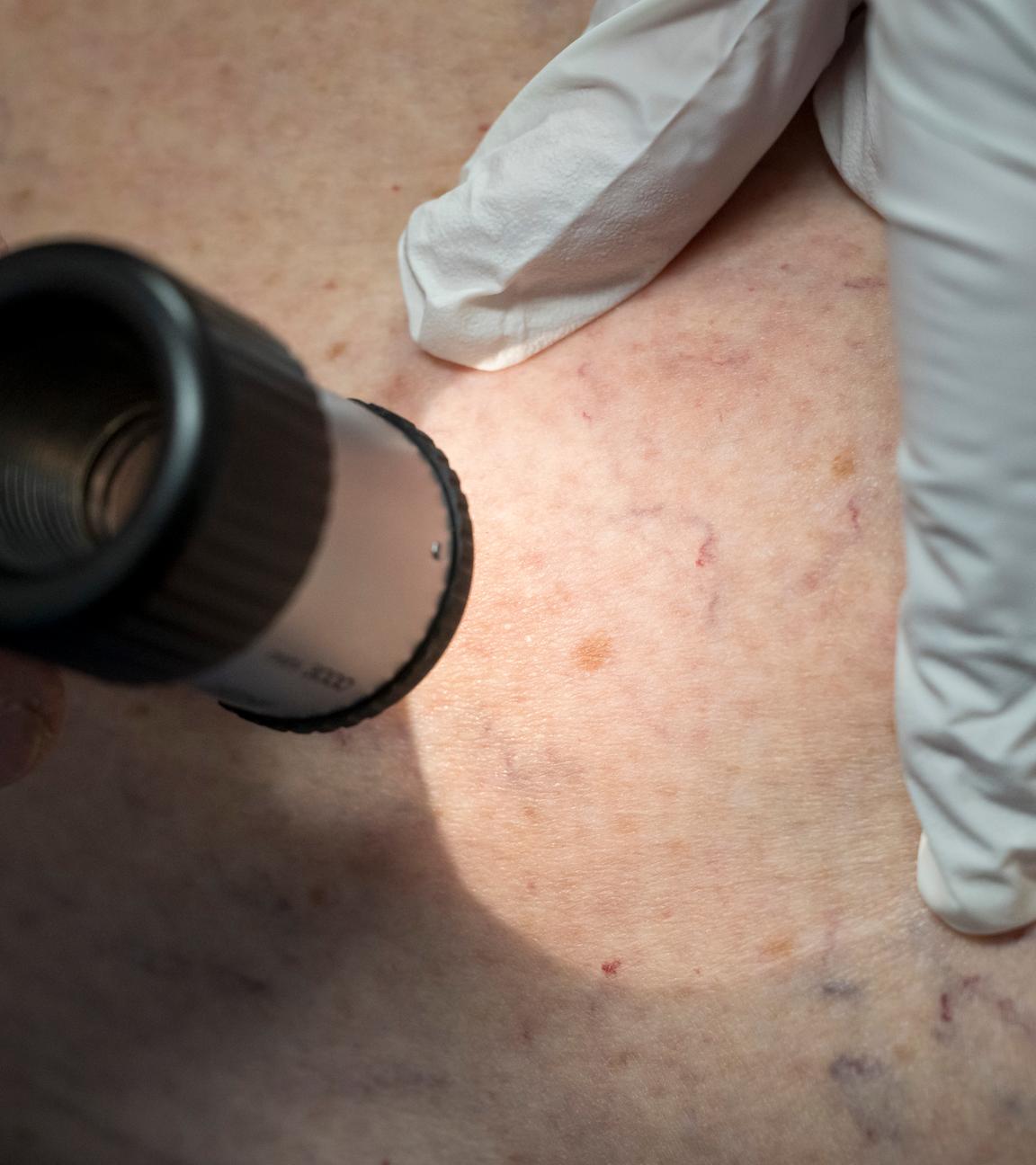 Ein Arzt untersucht mit einer Lupe die Hautpartie eines Patienten.