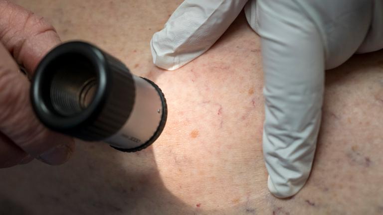 Ein Arzt untersucht mit einer Lupe die Hautpartie eines Patienten.