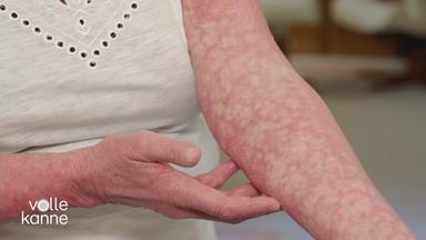 Ein Arm mit Flecken, der von der Krankheit Hautlymphome betroffen ist.