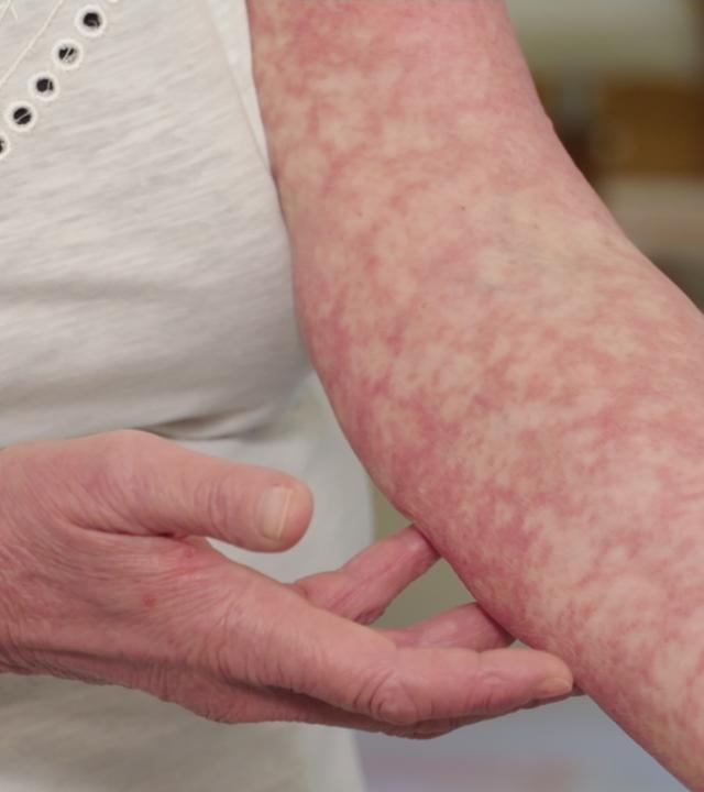 Ein Arm mit Flecken, der von der Krankheit Hautlymphome betroffen ist.