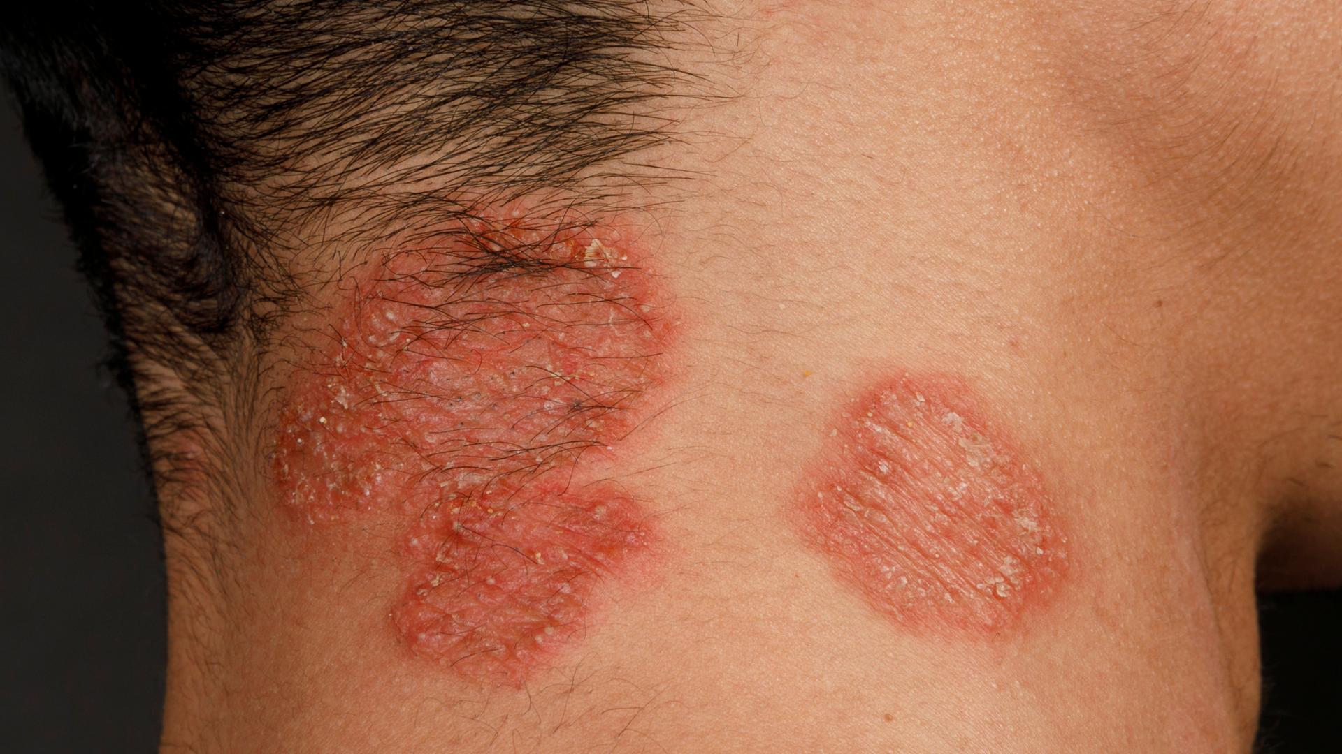 Am seitlichen Kopf und Hals von einem Mann sind runde, schuppige Stellen zu sehen, die durch eine Pilzinfektion hervorgerufen wurden.