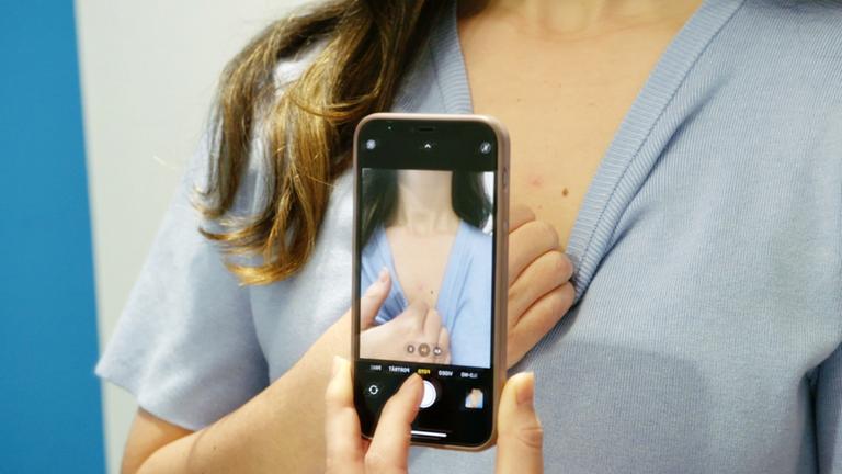 Eine Frau fotografiert mit dem Smartphone ein Muttermal auf ihrer Brust.