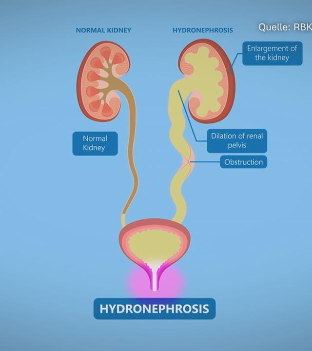 Schematische Darstellung der Nieren bei einer Hydronephrose.