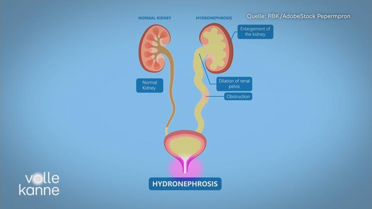 Schematische Darstellung der Nieren bei einer Hydronephrose.