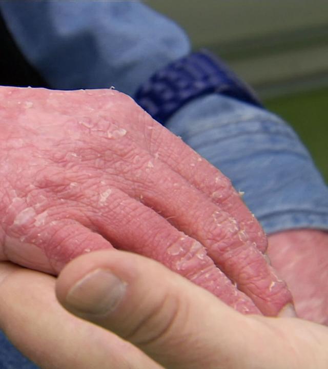 Hand mit Ichthyose