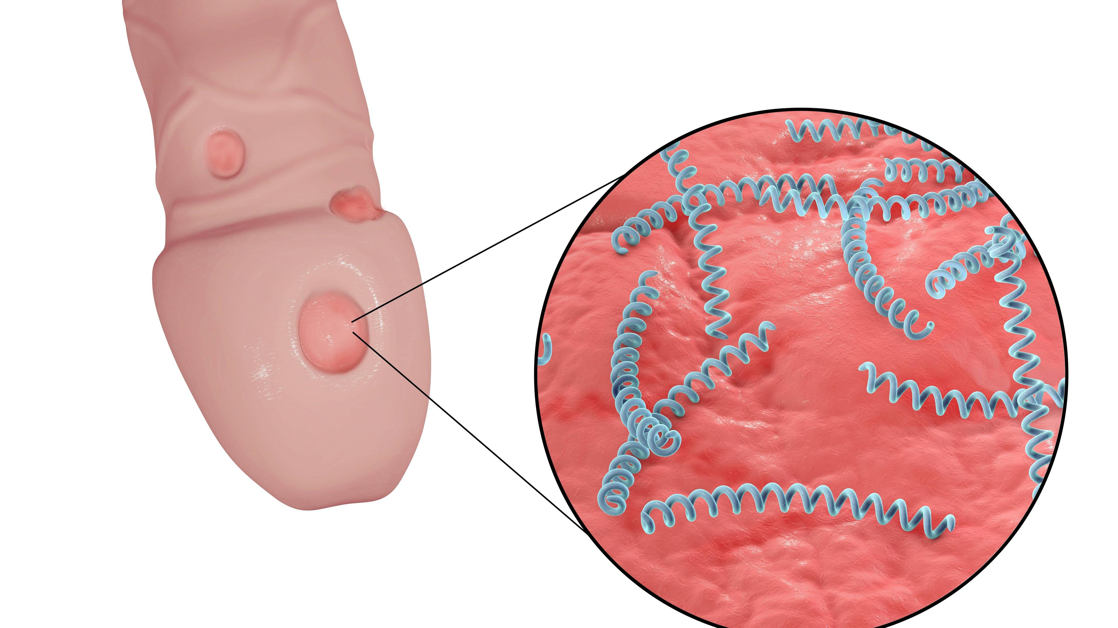 Illustration einer männlichen Syphilis-Infektion