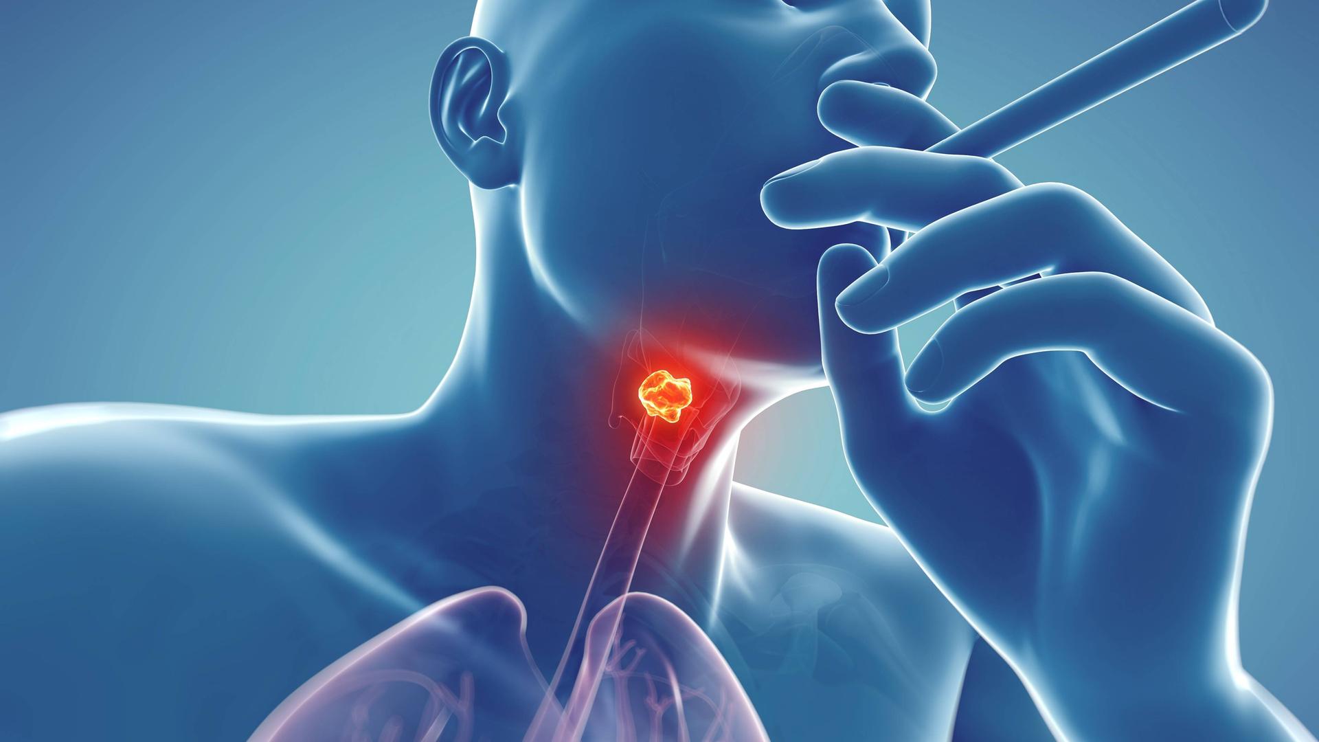 Kehlkopfkrebs Grafik