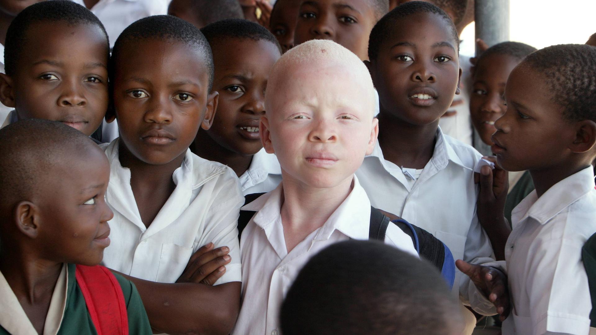Ein kleiner Junge mit Albininismus steht zwischen seinen schwarzen Klassenkameraden.