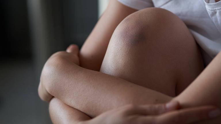 Ein Knie mit einem Bluterguss in Nahaufnahme, das von einem Arm umschlungen wird.