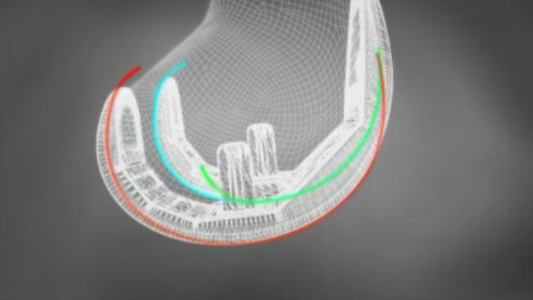 Computerberechnung Kniegelenk