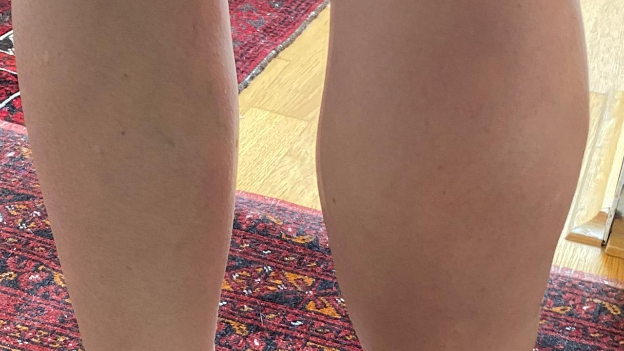 Die Unterschenkel einer Frau, wovon die eine Wade extrem angeschwollen und dicker ist als die andere.