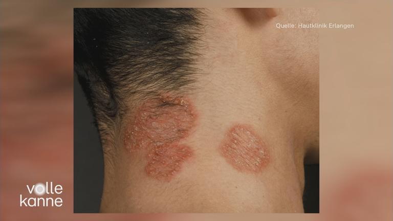 Kopfhautpilz erkennen und behandeln