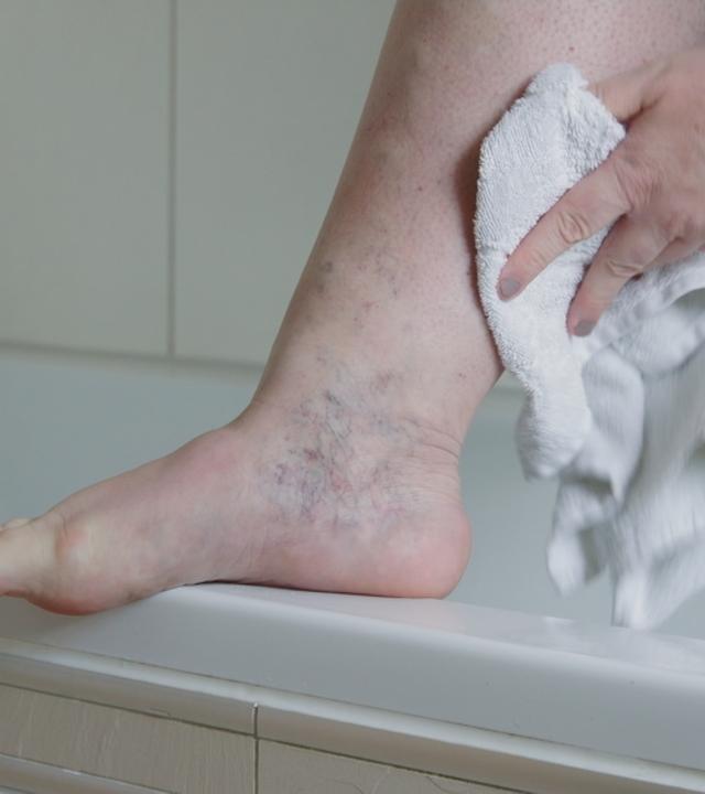 Krampfadern verhindern