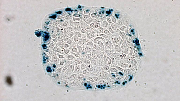 Mikroskopische Ansicht von Darmkrebszellen, denen von Wissenschaftlern genetisch veränderte E. coli Bakterien injiziert wurden.