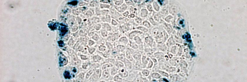 Mikroskopische Ansicht von Darmkrebszellen, denen von Wissenschaftlern genetisch veränderte E. coli Bakterien injiziert wurden.