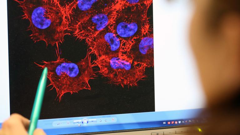 Rostock, 22.10.2013: Eine Doktorandin betrachtet im Labor des Instituts für Experimentelle Gentherapie und Tumorforschung  der Universitätsmedizin ein Bild von Melanomzellen.