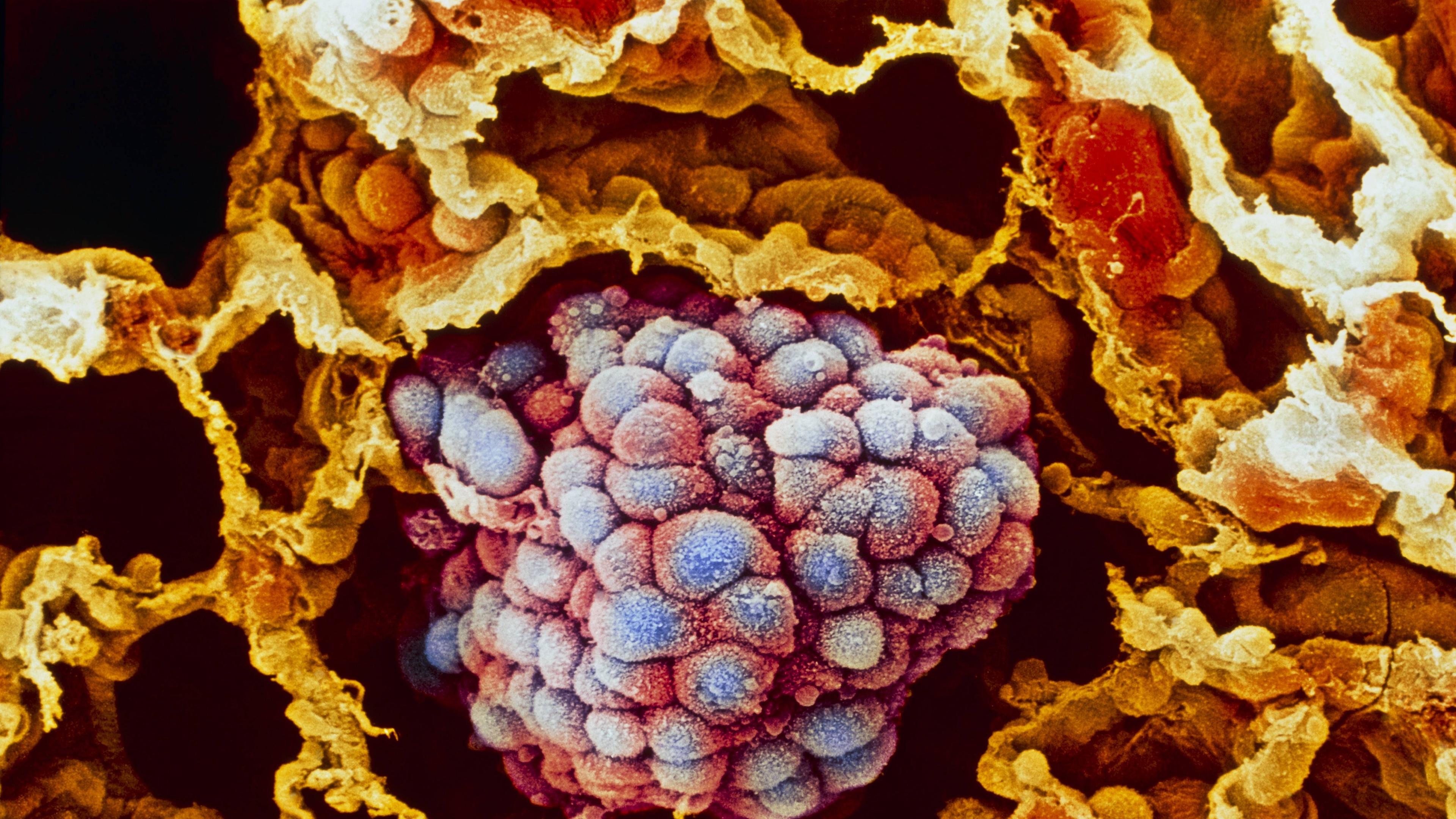 Tumor bei Lungenkrebs