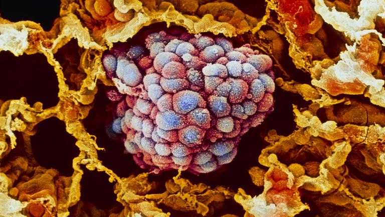 Tumor bei Lungenkrebs