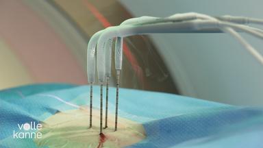 Behanldung von Tumoren mit Kryoablation.