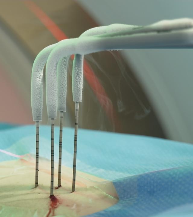 Behanldung von Tumoren mit Kryoablation.