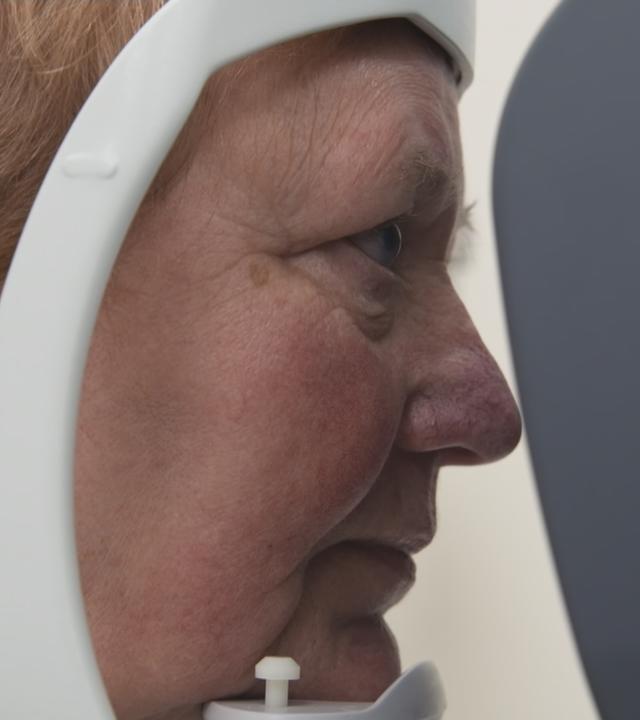 Eine Patientin ist bei einer Untersuchung nach der Hornhauttransplantation.