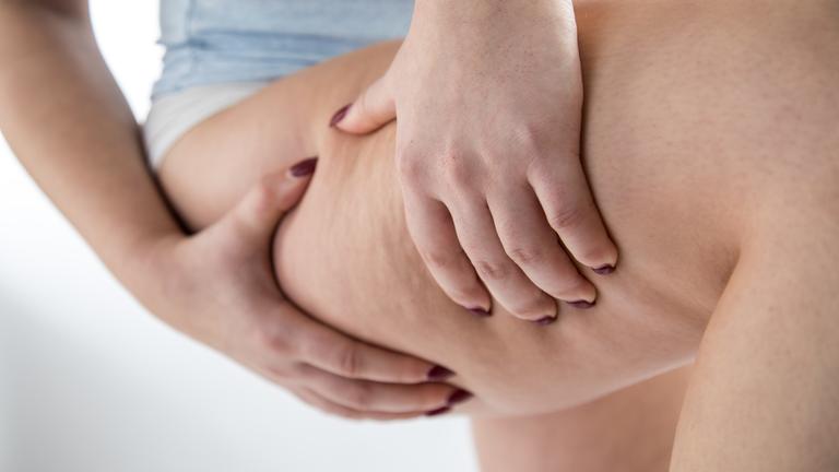 Eine Frau greift sich an den Oberschenkel mit Lipödem.