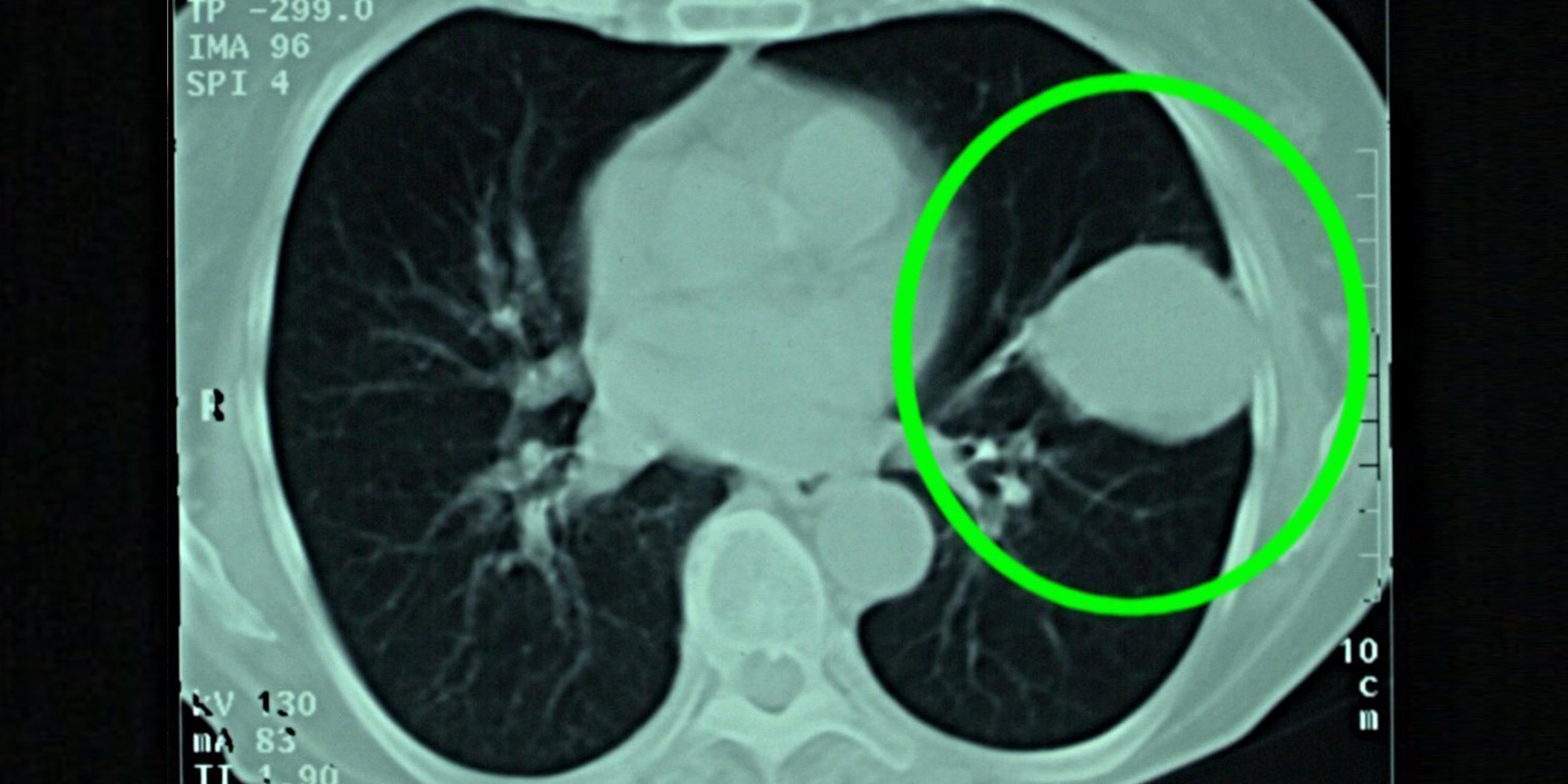 Die computertomographische Aufnahme einer Lunge im Jenaer Uni-Klinikum zeigt deutlich einen ausgeprägten Lungenkrebs (eingekreist). 