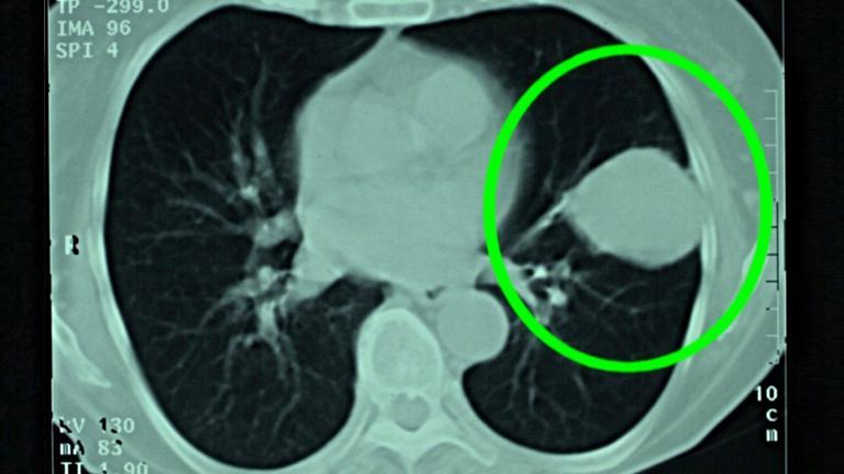 Die computertomographische Aufnahme einer Lunge im Jenaer Uni-Klinikum zeigt deutlich einen ausgeprägten Lungenkrebs (eingekreist). 