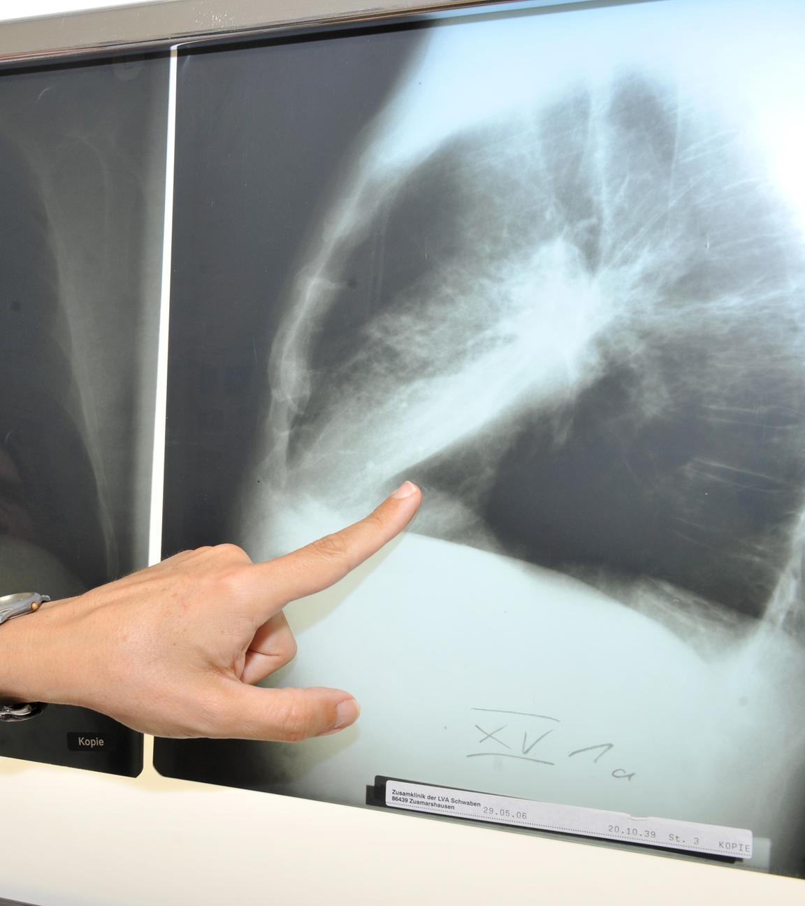 Ein Arzt zeigt auf ein Röntgenbild einer von Krebs befallenen Lunge.