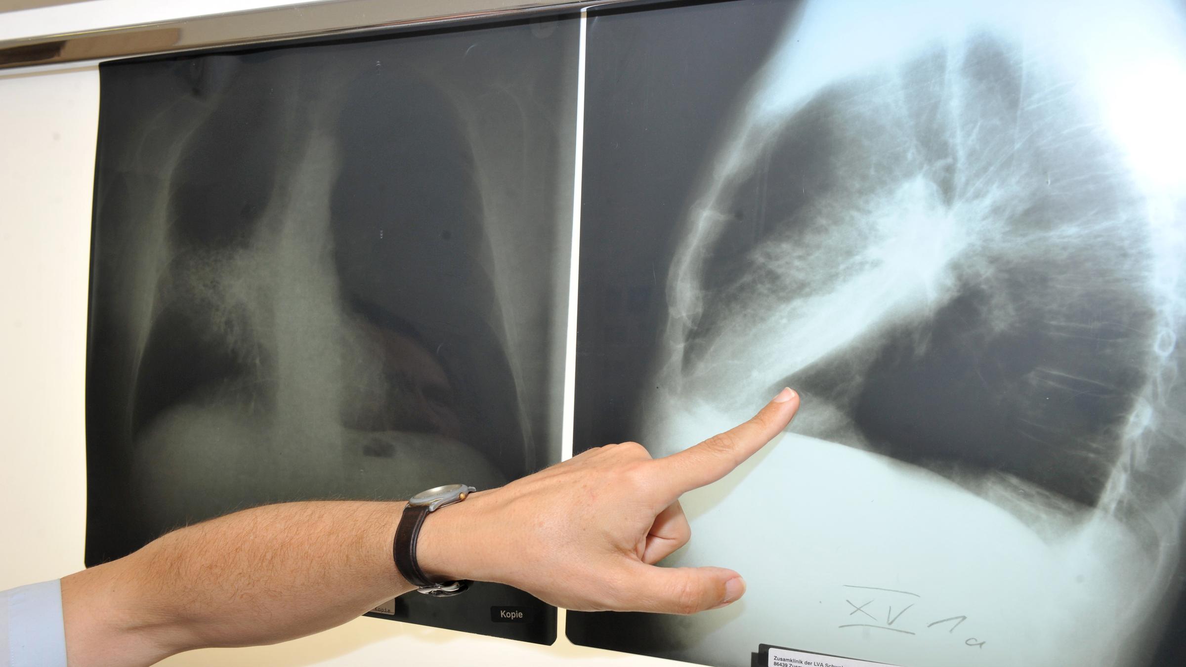 Röntgenbild einer von Krebs befallenen Lunge. Archivbild