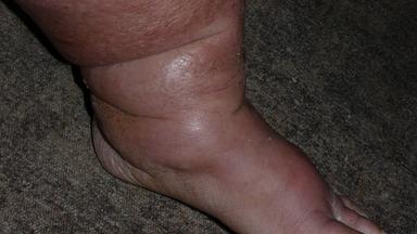 Im Endstadium eines Lymphödems kann es zur sogenannten Elephantiasis kommen.