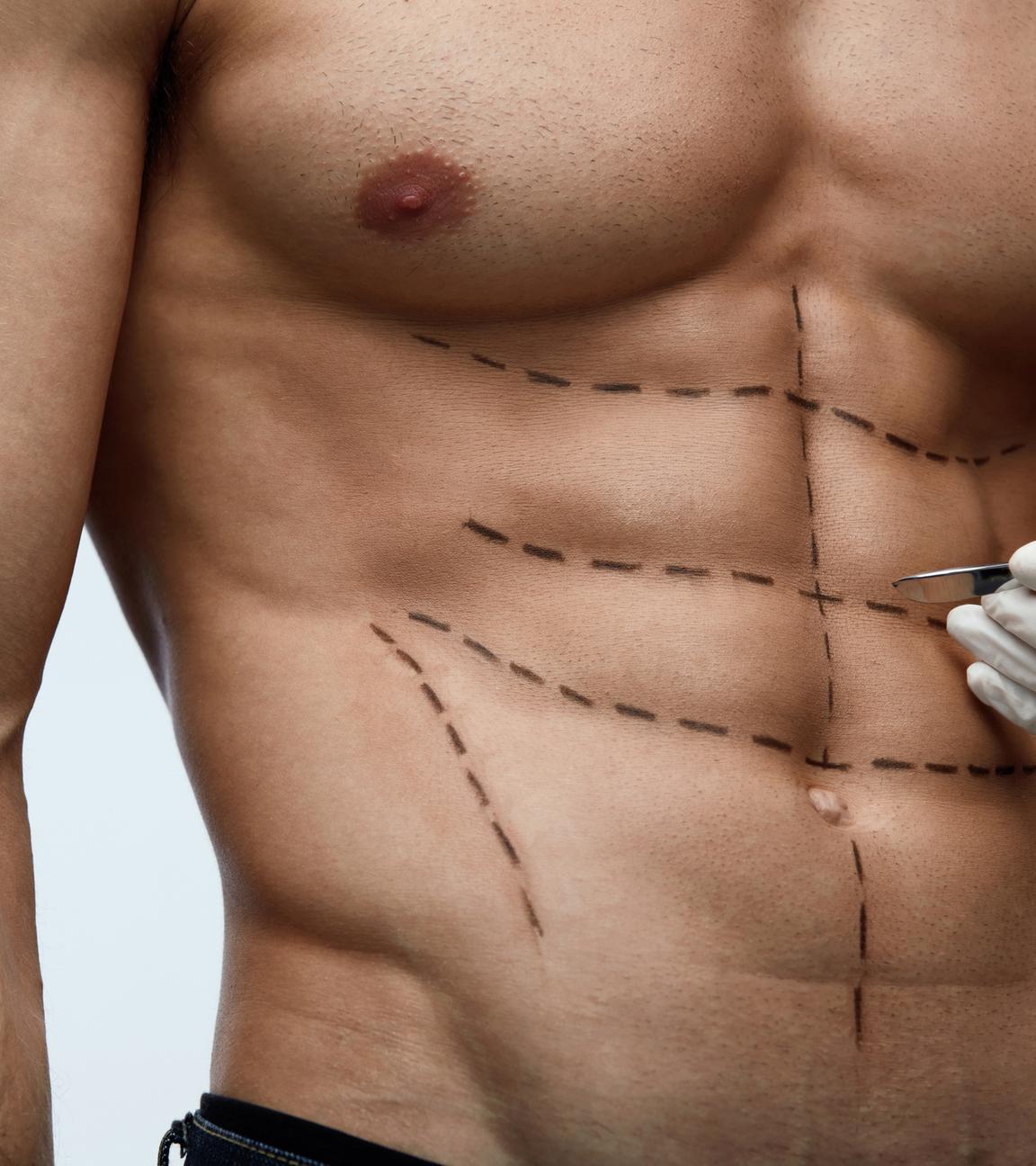 Ein männlicher durchtrainierter Oberkörper ist mit Linien gekennzeichnet, an der Seite ist davor eine Hand mit einem Skalpell.