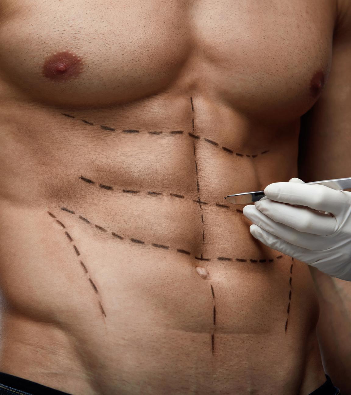 Ein männlicher, durchtrainierter Oberkörper ist mit Linien gekennzeichnet, an der Seite ist davor eine Hand mit einem Skalpell.