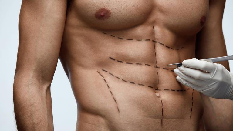 Ein männlicher, durchtrainierter Oberkörper ist mit Linien gekennzeichnet, an der Seite ist davor eine Hand mit einem Skalpell.