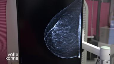 Röntgenbild einer Brust (Mammograpfie)