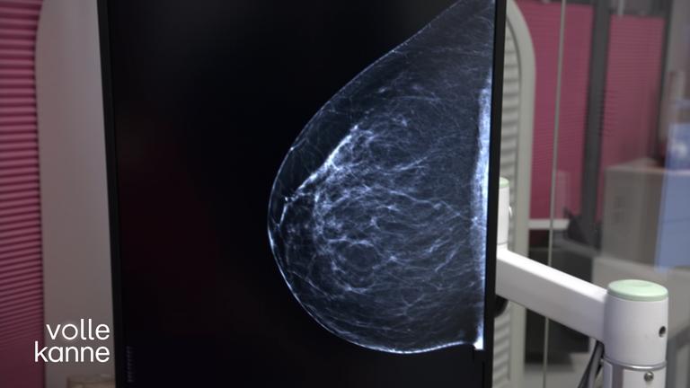 Röntgenbild einer Brust (Mammograpfie)