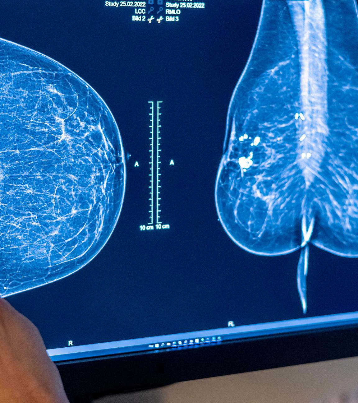 Medizinisches Personal untersucht mit einer Mammografie die Brust einer Frau auf Brustkrebs, aufgenommen am 25.02.2022