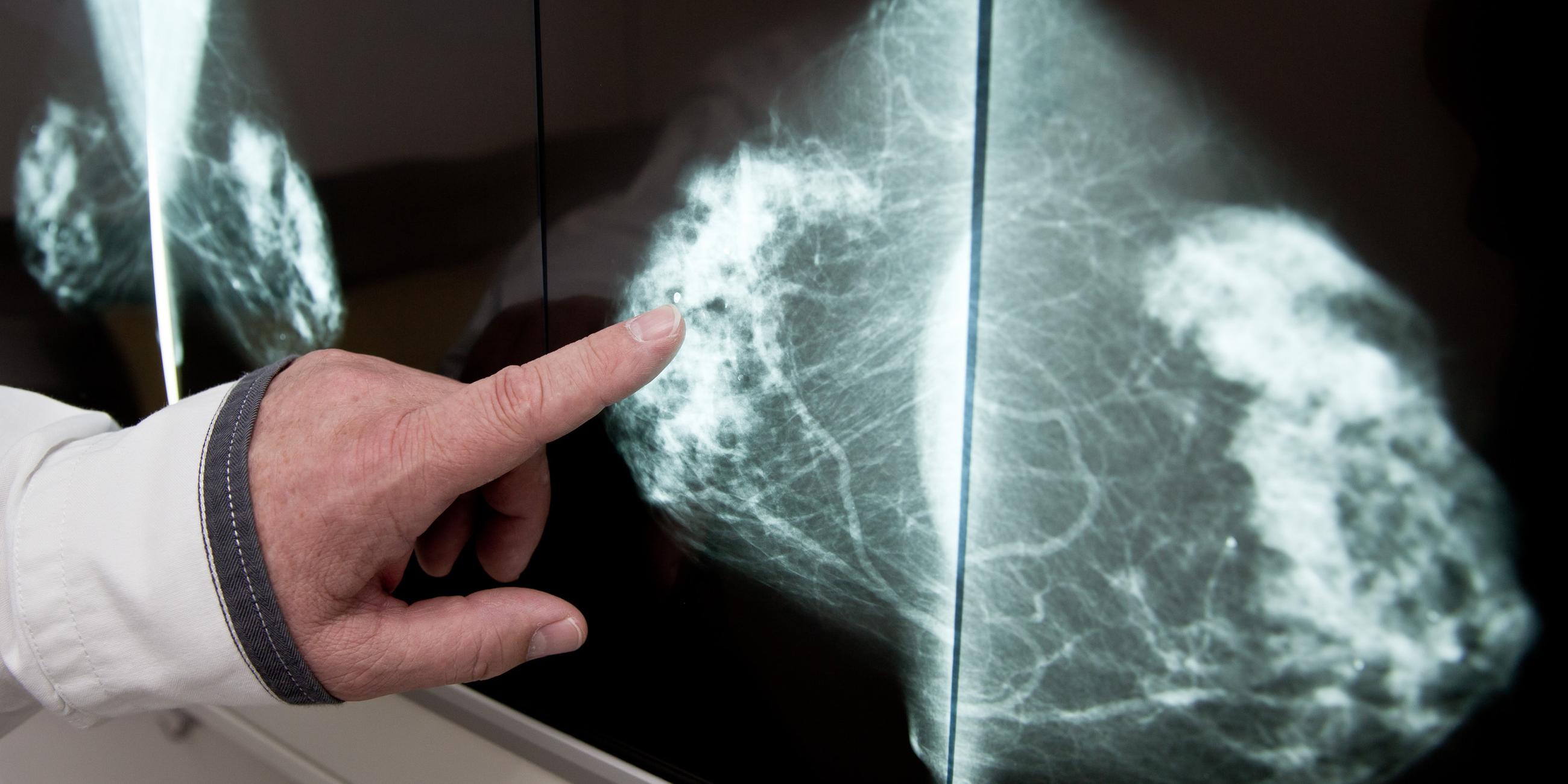 Medizinisches Personal untersucht mit einer Mammographie die Brust einer Frau auf Brustkrebs