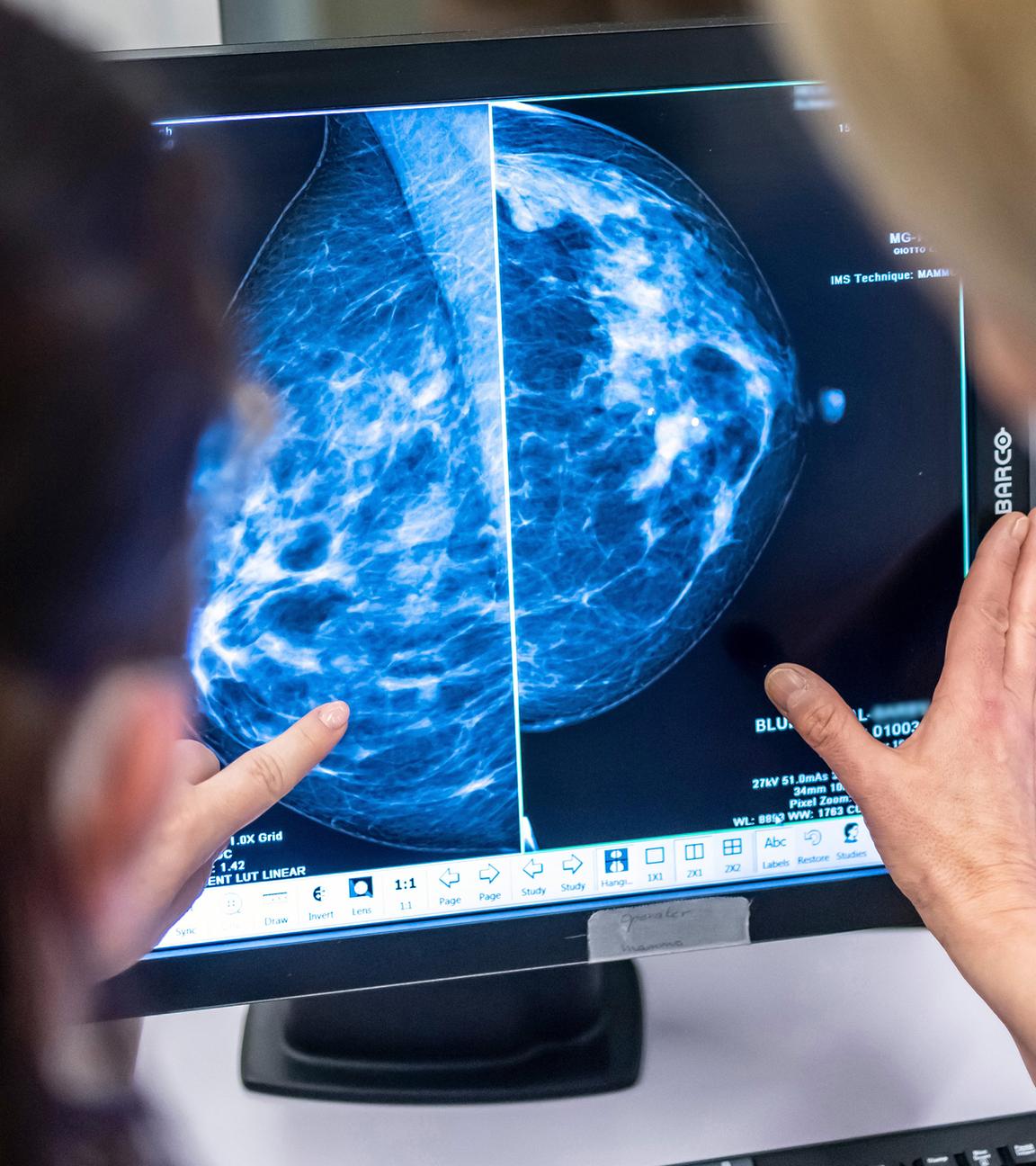 Mammographie für Brustkrebsuntersuchung