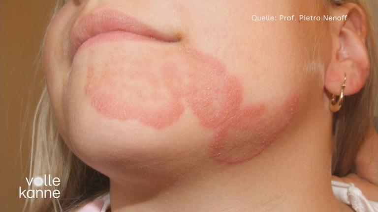 Meerschweinchen überträgt Hautpilz