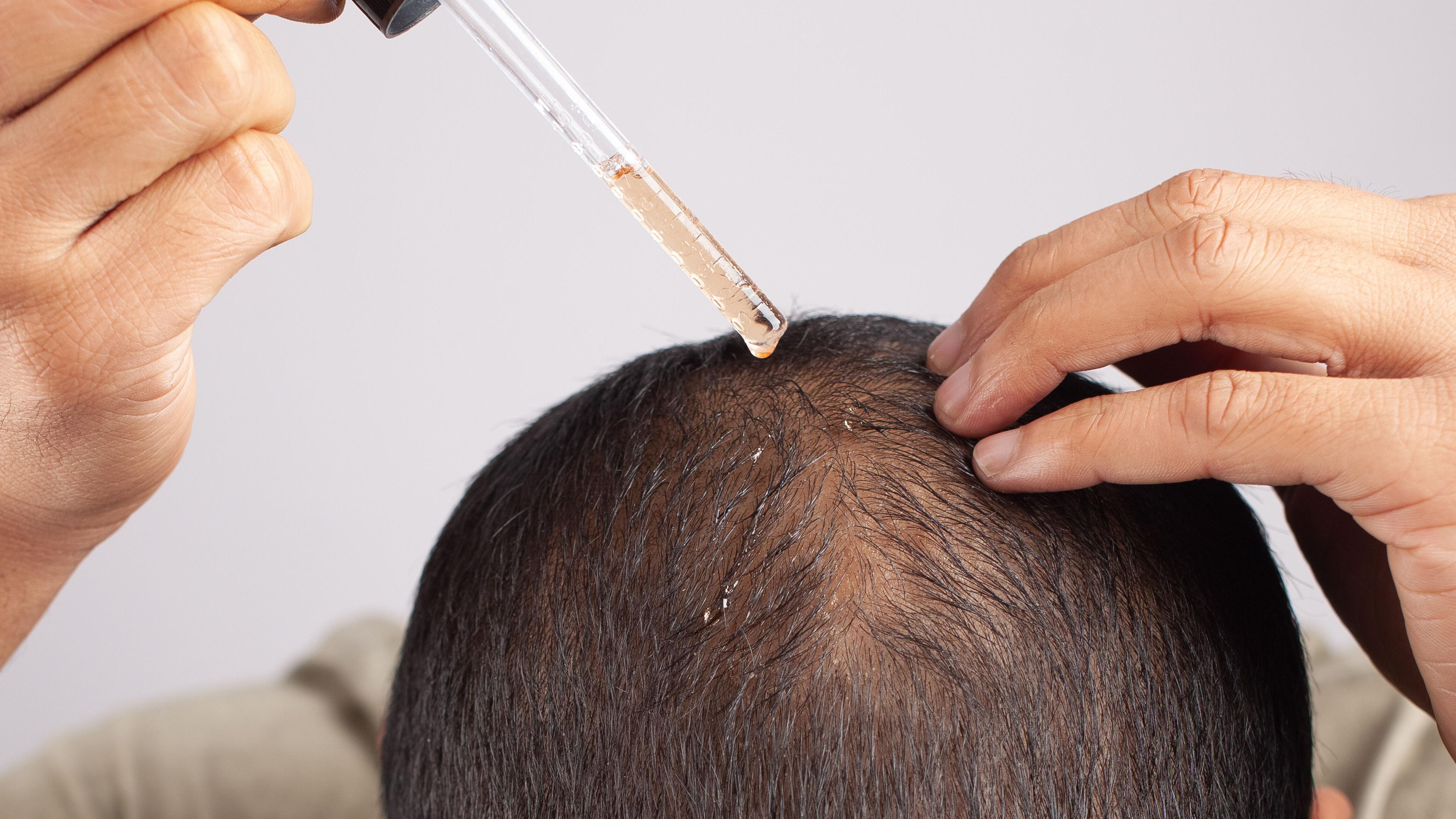 Ein Mann verteilt mit einer Pipette das Haarwuchsmittel Minoxidil auf seiner Kopfhaut.