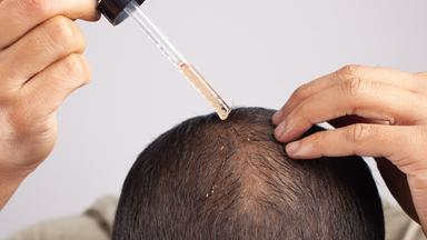 Ein Mann verteilt mit einer Pipette das Haarwuchsmittel Minoxidil auf seiner Kopfhaut.