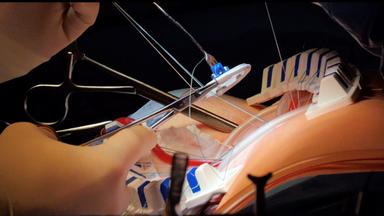 Minimalinvasive Operation bei einer Mitralklappeninsuffizienz.Dabie wird die defekte Herzklappe repariert und mit einem Ring stabilisiert.